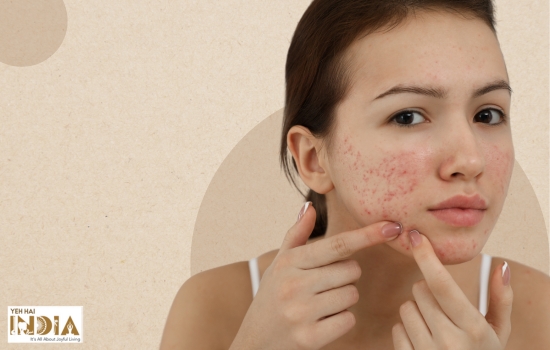 How To Get Rid Of Acne Scars