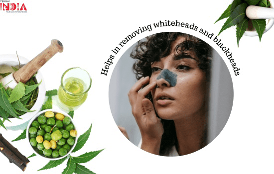 Neem Helps in removing whiteheads and blackheads