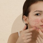 How To Get Rid Of Acne Scars