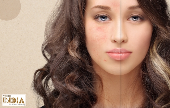 10 Natural Remedies to Treat Acne Scars